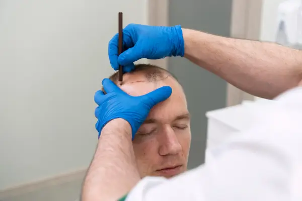 Reseñas de la técnica FUE Zafiro - Clínica facial Reseñas de la Técnica Zafiro FUE