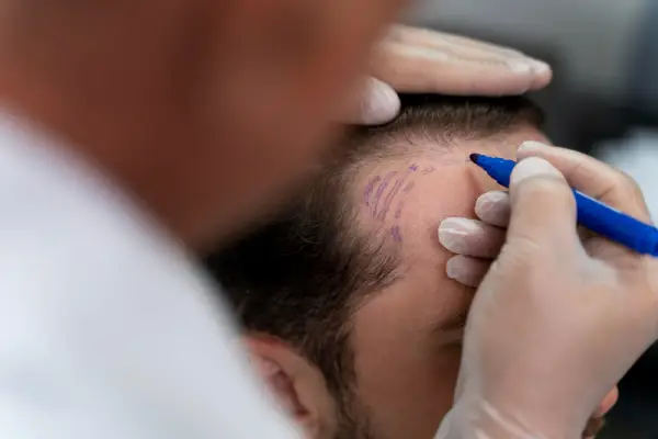 Técnica FUE Zafiro España - Clínica Facial FUE Técnica Zafiro España