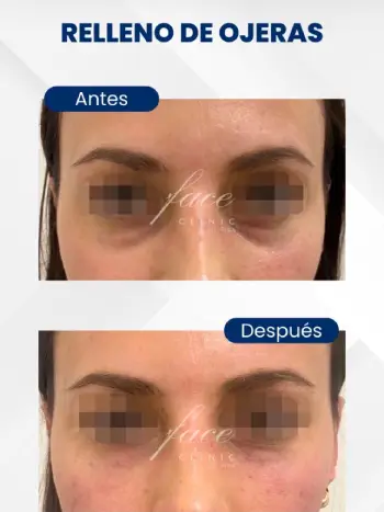 Ojeras con ácido hialurónico antes y después - Face Clinic Spain Ojeras con ácido hialurónico antes y después.