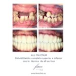 Rehabilitación dental completa: caso de transformación inmediata