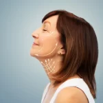 Mini lifting facial: qué es, indicaciones y precio