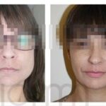 ¿Cómo relajar la mandíbula por bruxismo?