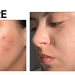 Análisis del cuidado de la piel Face Reality: resultados de antes y después