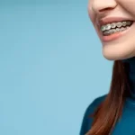 Ortodoncia: ¿moda o necesidad?
