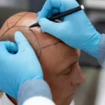 Trasplante capilar a los 50: confianza y resultados