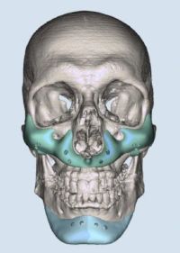 Plantas para la interrupción nasogénica - Clínica facial Plantas para surcos nasogénicos