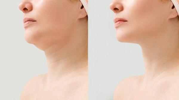 Tratamientos para rejuvenecer el cuello 4 Eliminar el cuello de pavo