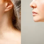 Rejuvenecer el cuello con resultados naturales