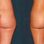 ▷ LipoVaser: todo lo que necesitas saber