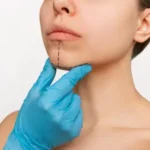 ¿Qué riesgos implica la mentoplastia?