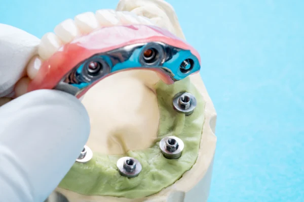Prótesis removibles o implantes dentales: una guía para pacientes 5