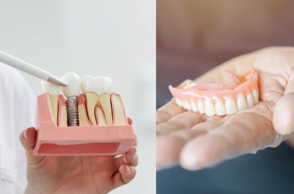 Prótesis removibles o implantes dentales: una guía para pacientes 3 Comparación entre implantes dentales fijos y prótesis removibles en Face Clinic