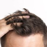 Caída del cabello en hombres: causas y cuando preocuparse