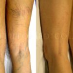 Cómo eliminar las varices sin cirugía: técnicas