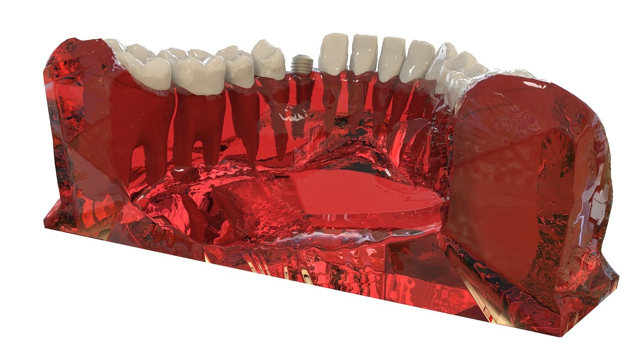Rechazo y fracaso de los implantes dentales: causas y soluciones. 4 Rechazo del tratamiento con implantes.
