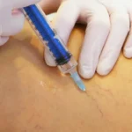 ▷ Guía de escleroterapia de varices