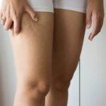 ▷ Cómo saber la diferencia entre lipedema y celulitis