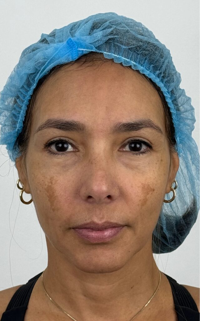 REDENSIFY, REVITALIZE, REPOSITION. THE THREE PILLARS OF FACIAL REJUVENATION.
